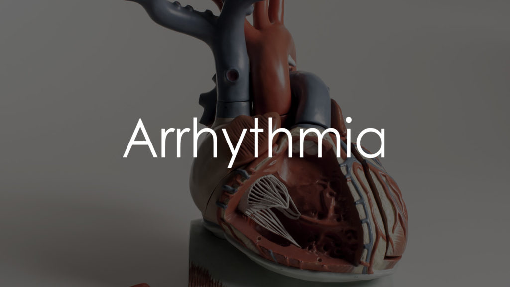 Arrhythmia