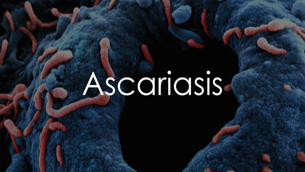 Ascariasis