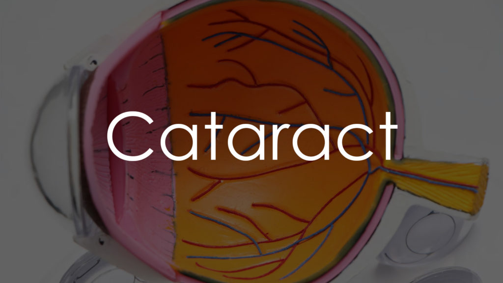 Cataract