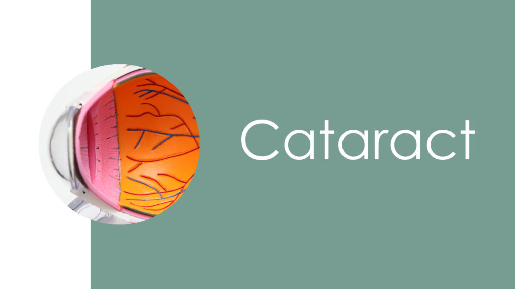 Cataract 2