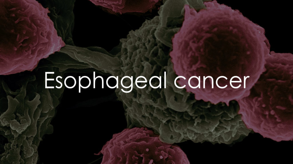 Esophageal cancer