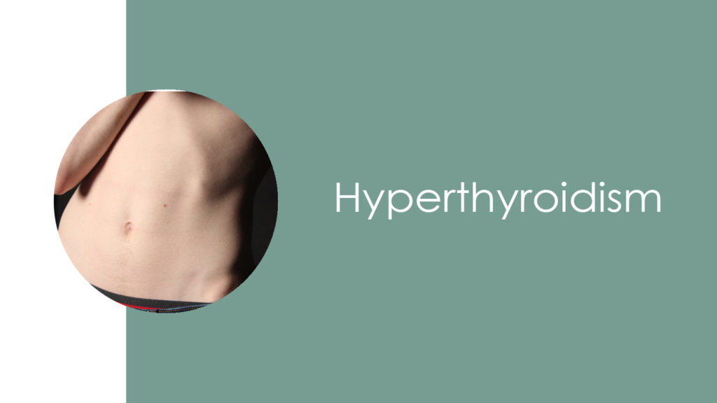 Hyperthyroidism2