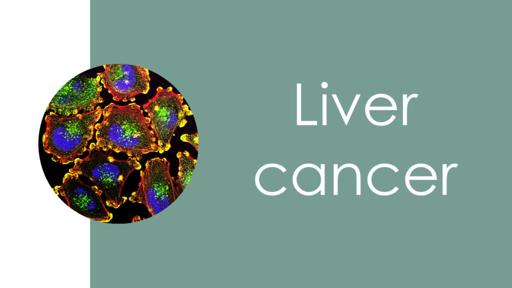 Liver cancer3