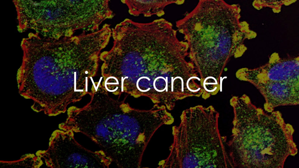 Liver cancer