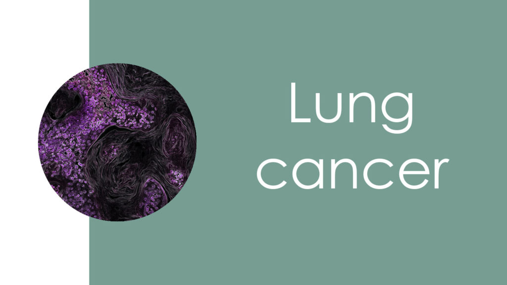 Lung cancer3