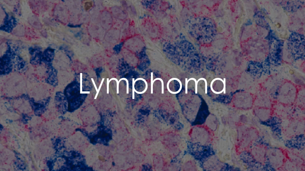 Lymphoma