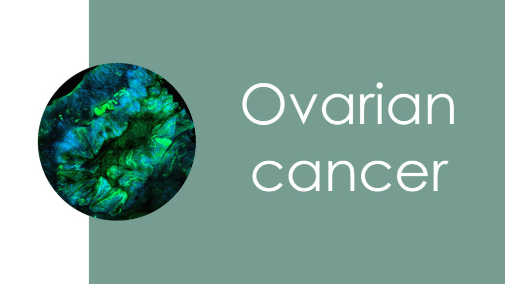 Ovarian cancer3