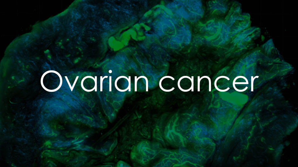 Ovarian cancer2