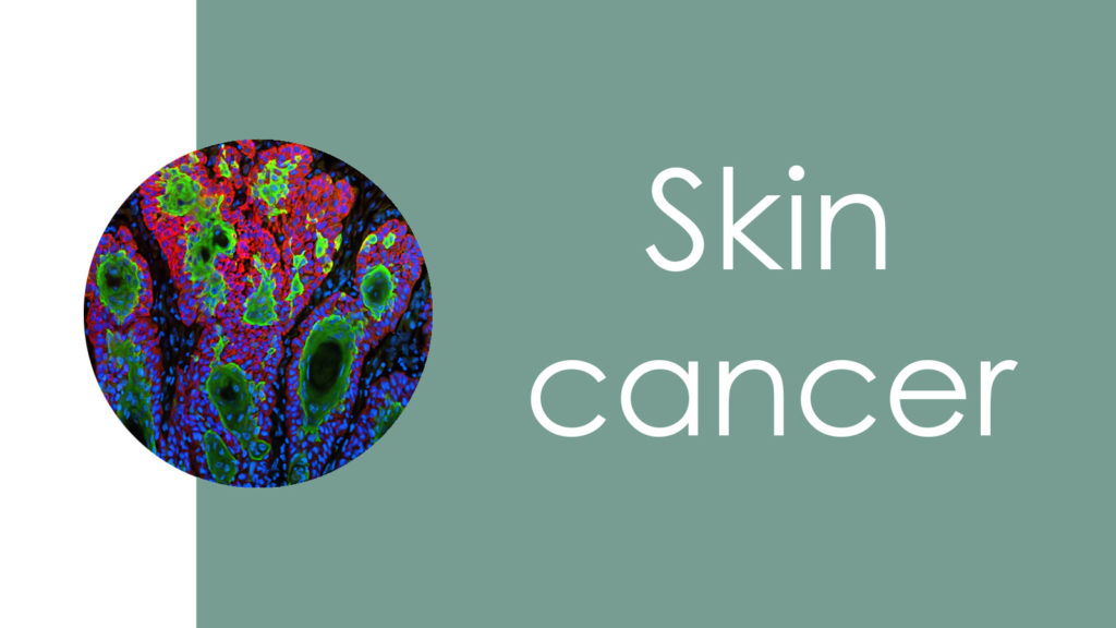 Skin cancer3