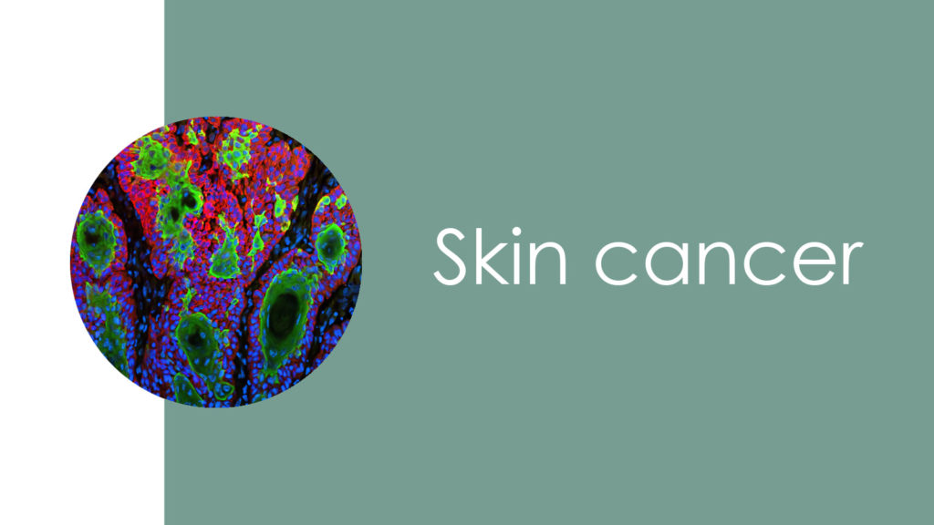 Skin cancer 2