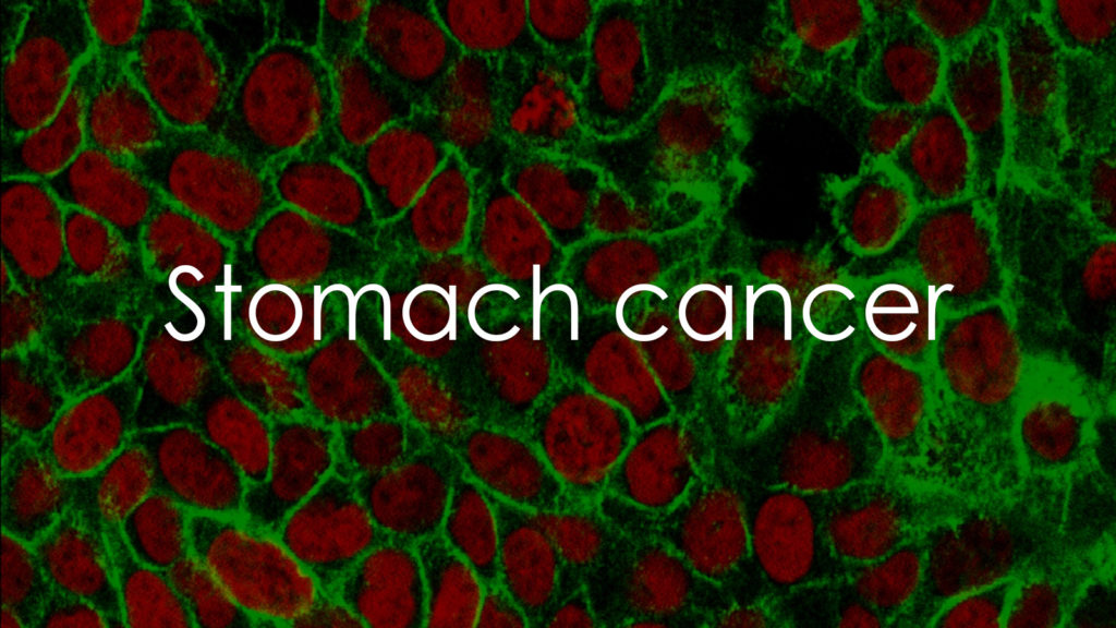 Stomach cancer