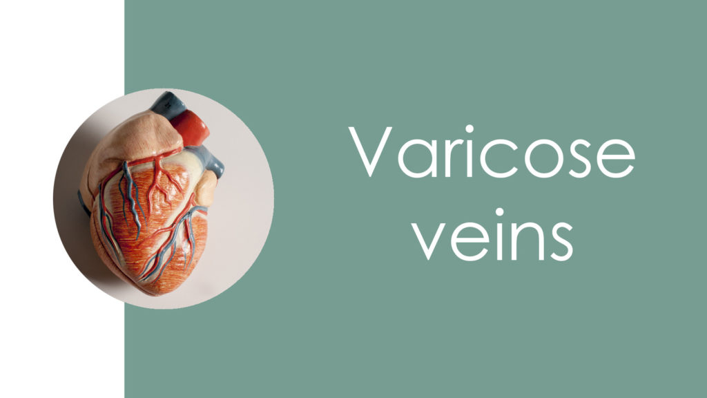 Varicose veins3