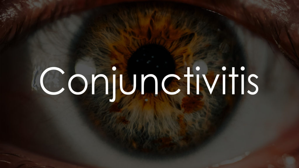 Conjunctivitis