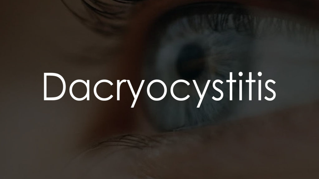 Dacryocystitis