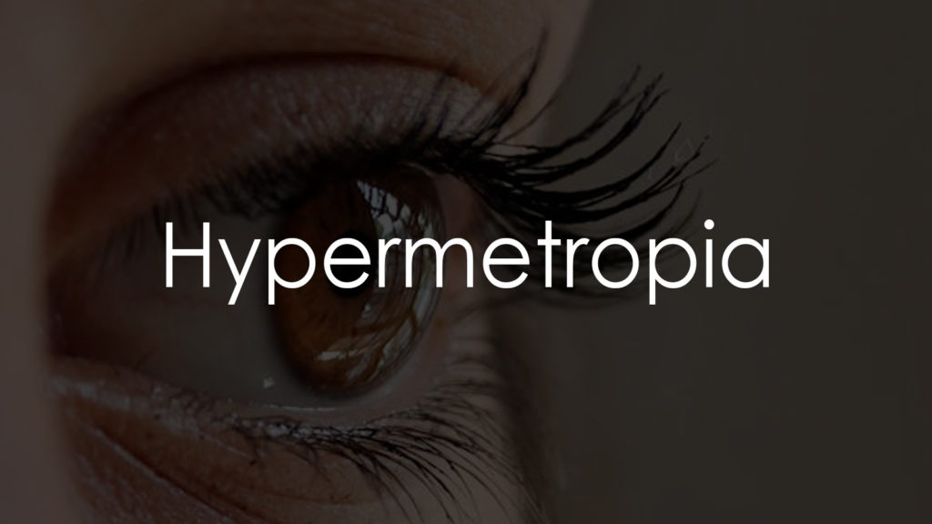 Hypermetropia