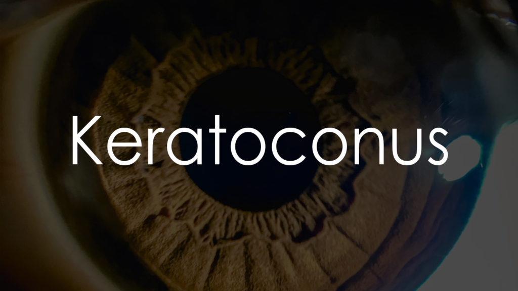 Keratoconus