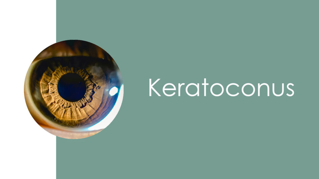 Keratoconus2