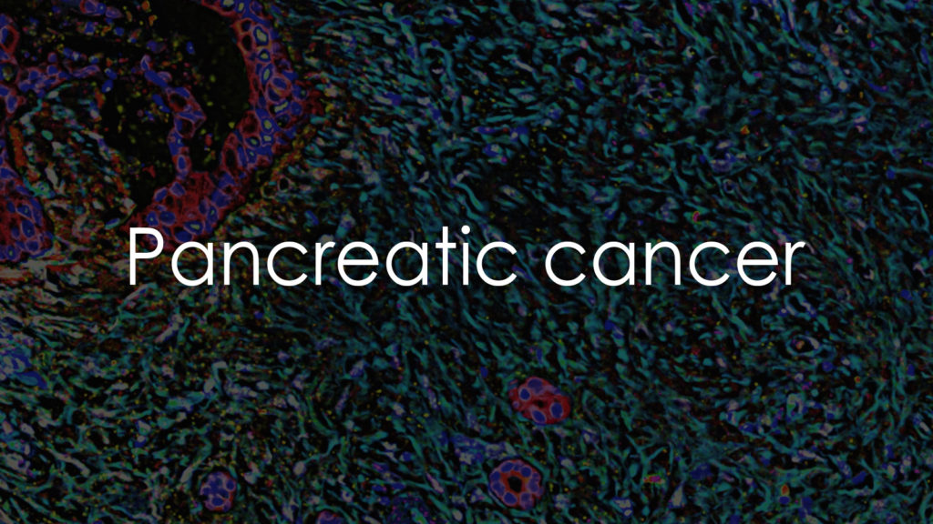 Pancreatic cancer3