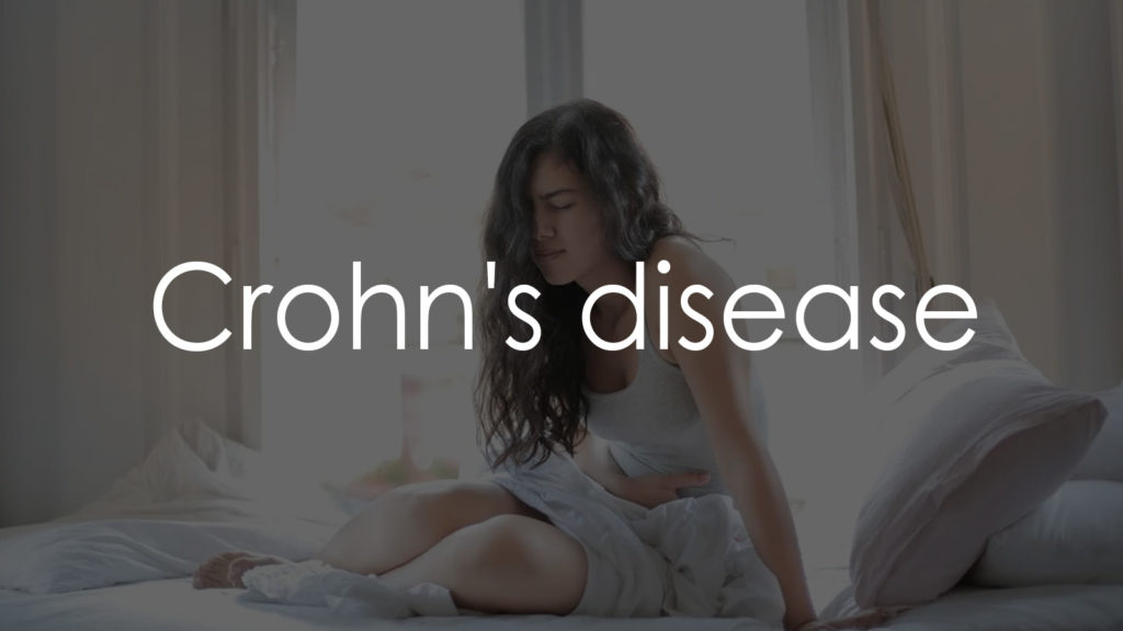 Crohns-disease