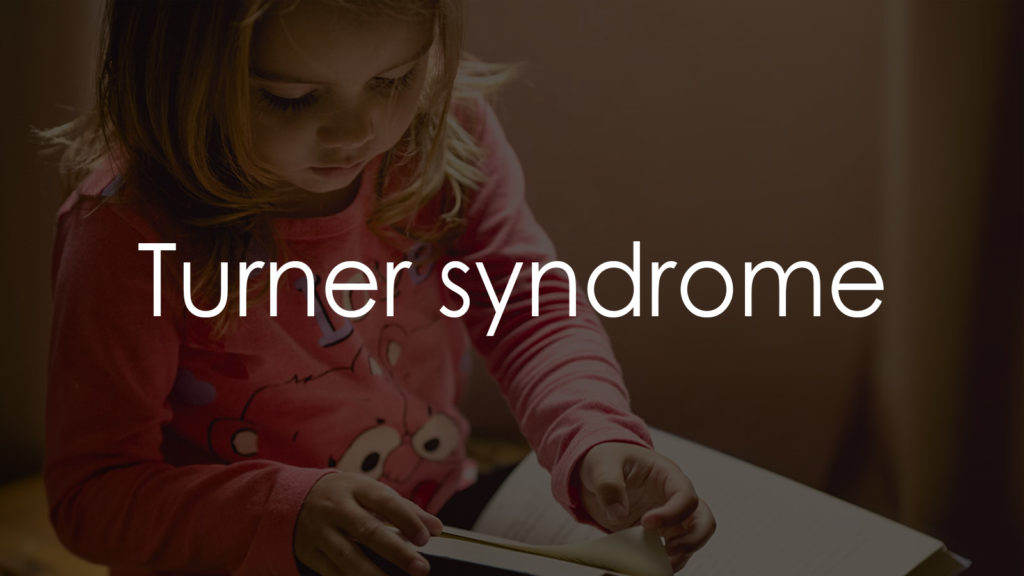 Turner syndrome4